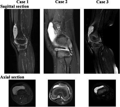 Rice body synovitis in pediatrics: three different case reports